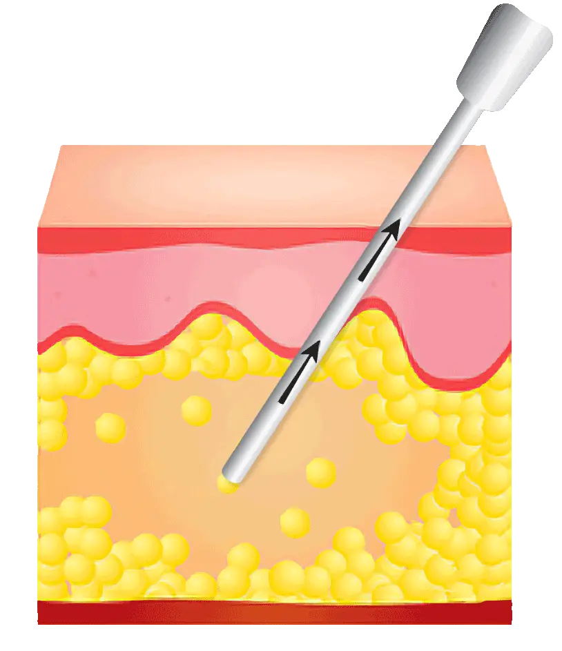 Liposuctie uitleg infographic