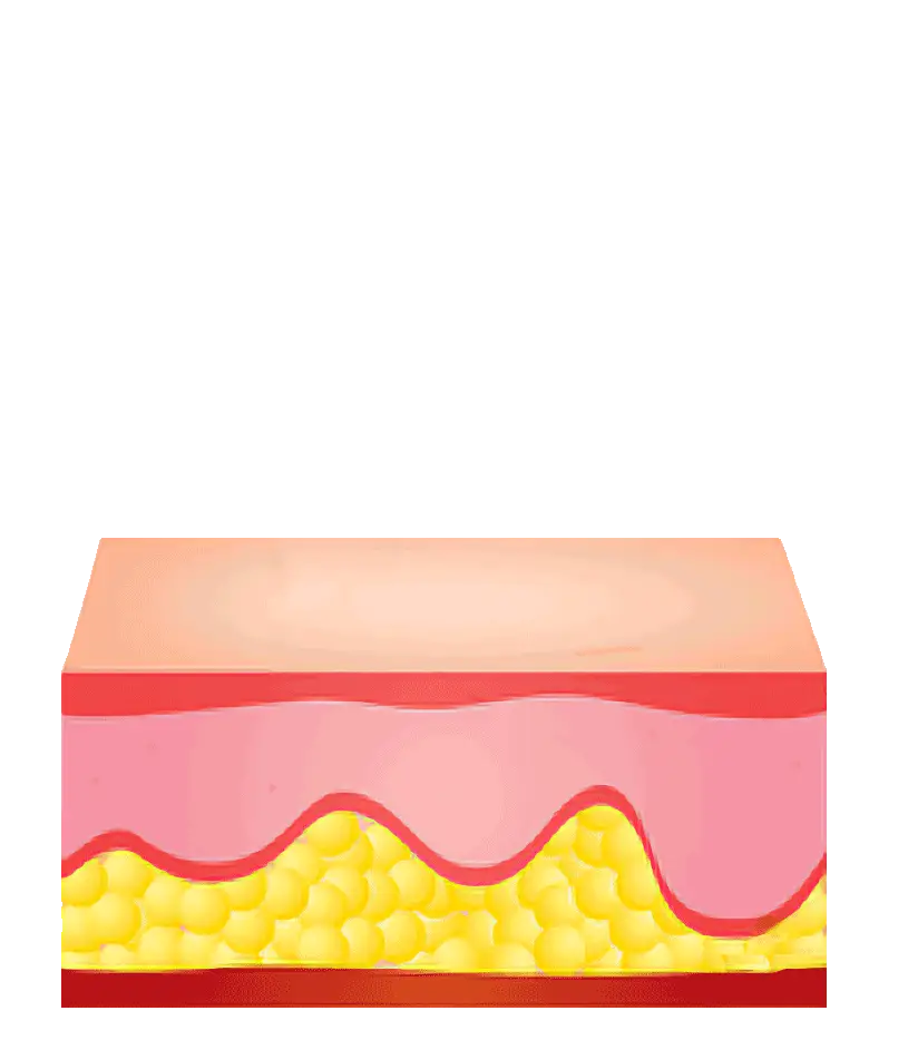 Liposuctie uitleg infographic