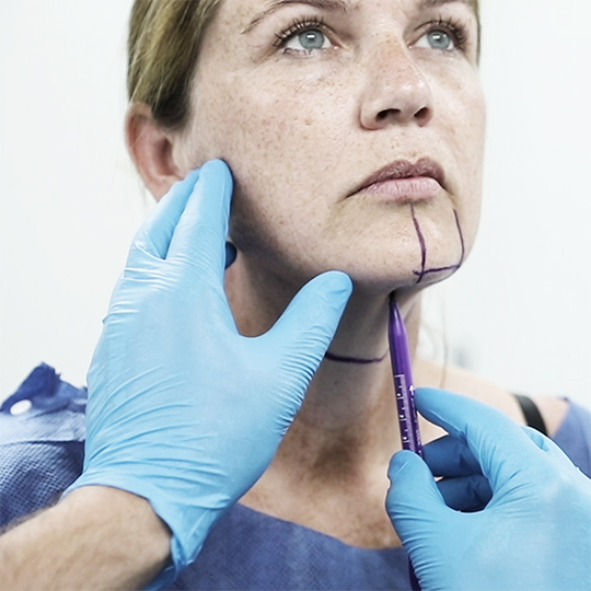 resculpt clinic, belkyra, onderkin, amsterdam