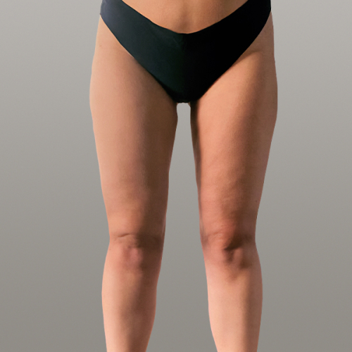 lipoedeem, resculpt clinic, lipoedeem benen, lipoedeem ervaring, lipoedeem voor na