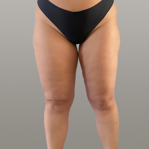 lipoedeem, resculpt clinic, lipoedeem benen, lipoedeem ervaring, lipoedeem voor na