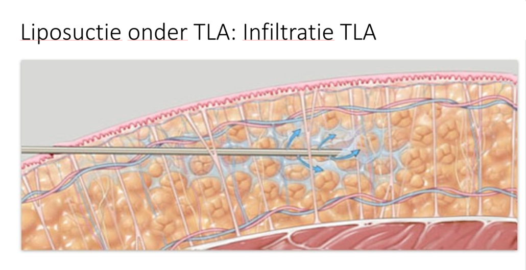 Liposuctie onder TLA, schematische tekening met uitgebeeld de infiltratie TLA