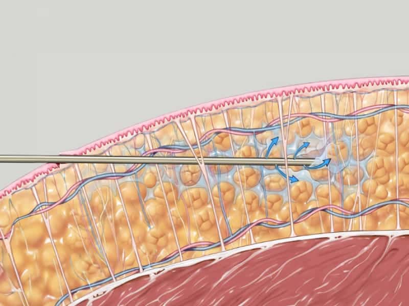 tumescente liposuctie, liposuctie behandeling, liposculpture, resculpt clinic